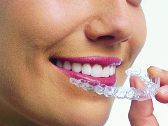 aparat dentar transparent aparat dentar transparent