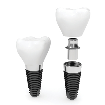 Implantul dentar
