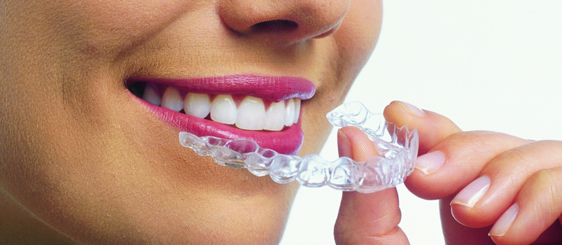 aparata dentar transparent