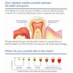 What is a periodontal (gum) chart?