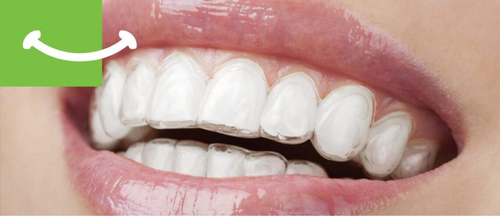 Dreossi Dental - Aparat dentar