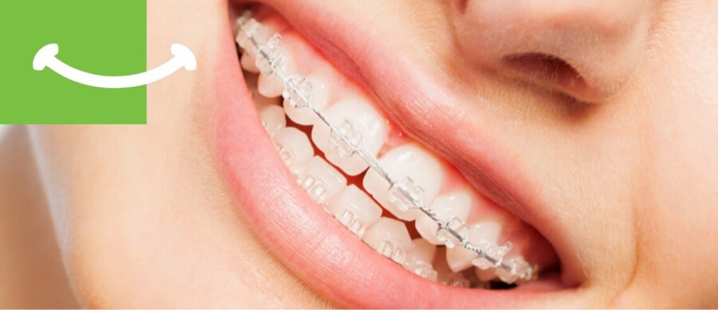 Dreossi Dental - Aparat dentar